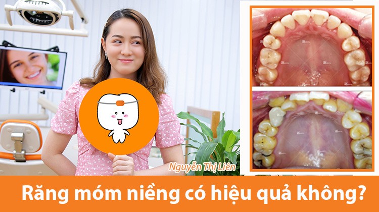 Răng móm niềng có hiệu quả không: Kinh nghiệm từ cô nàng Thị Liên 26 tuổi