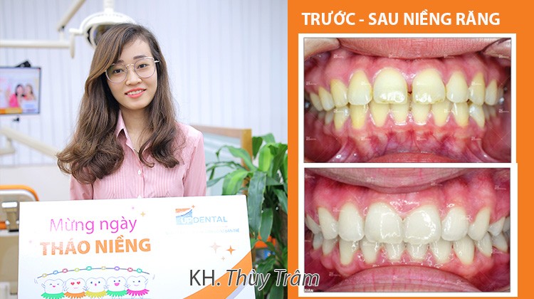Quyết định niềng răng hô - thưa 2 năm, cô giáo 25 tuổi lo lắng ảnh hưởng giọng nói