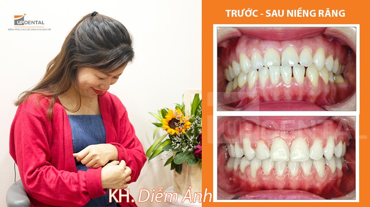 Răng thưa thay đổi như thế nào khi niềng răng? - Review niềng răng Diễm Ánh (30 tuổi)