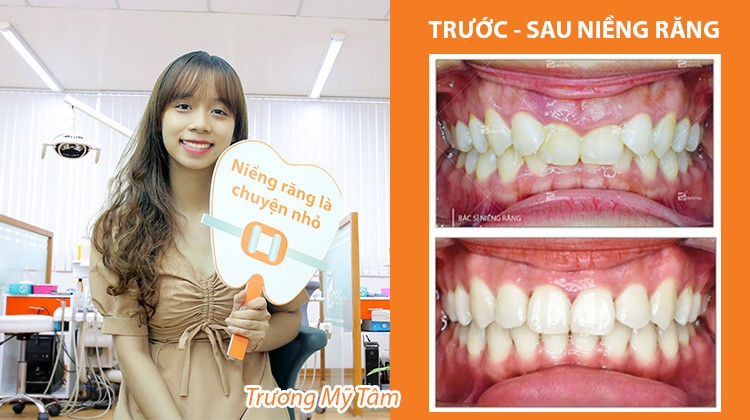 Tự ti vì bạn bè trêu chọc hàm răng xấu, nữ sinh Hutech quyết định niềng răng