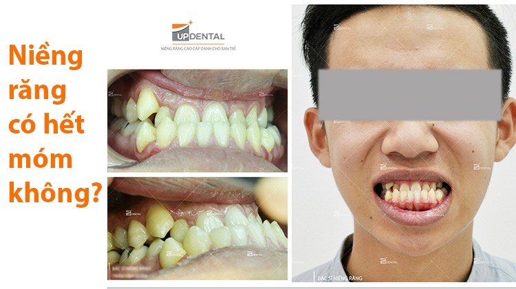 Niềng răng có hết móm hay không? Câu trả lời từ chuyên gia của Up Dental