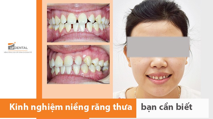Kinh nghiệm niềng răng thưa bạn cần biết