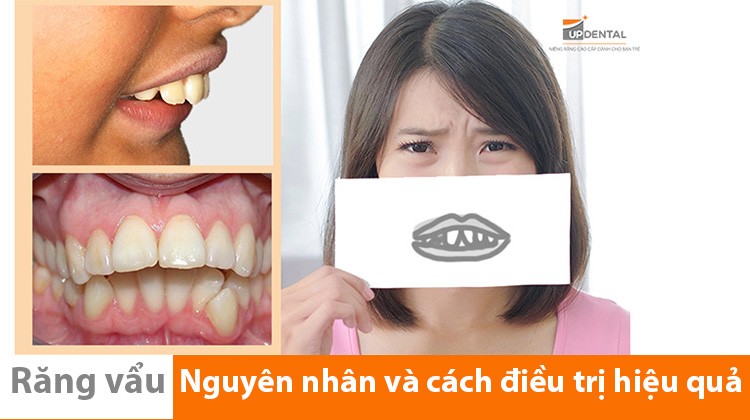 Niềng răng vẩu - bạn đã biết những điều này chưa?