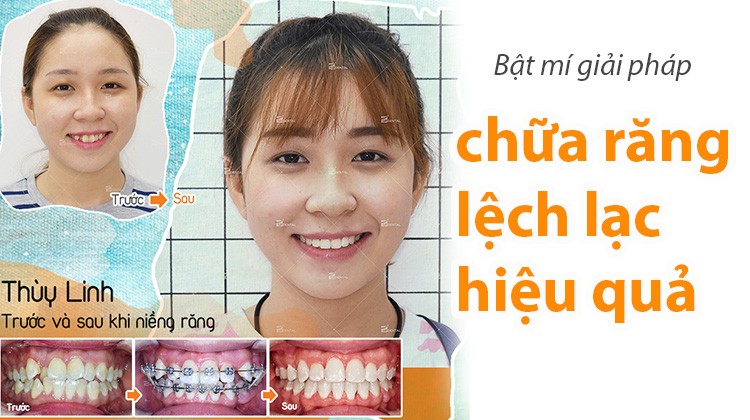 Niềng răng lệch lạc - giải pháp hiệu quả điều trị răng lộn xộn