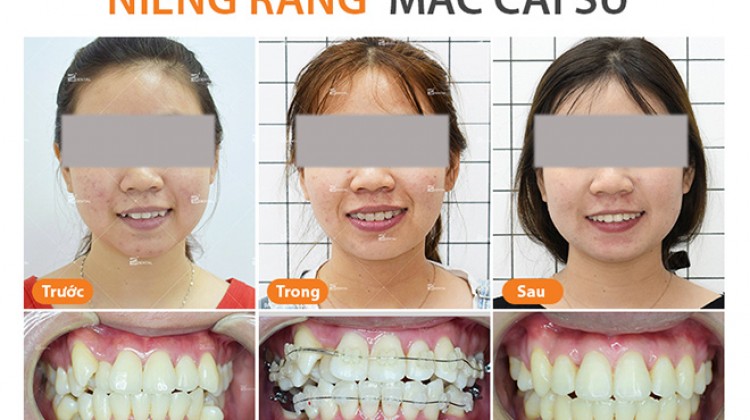Những điều bạn cần biết về niềng răng mắc cài sứ