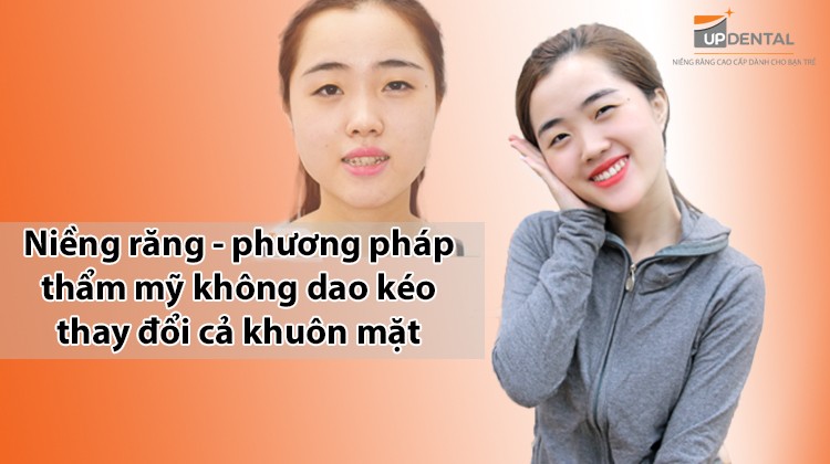 Niềng răng - phương pháp thẩm mỹ không dao kéo thay đổi cả khuôn mặt