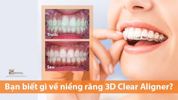 Bạn biết gì về niềng răng 3D Clear Aligner?