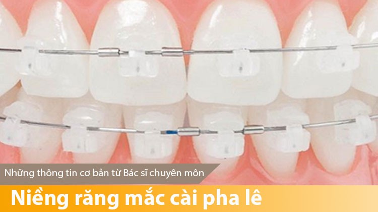 Niềng răng mắc cài pha lê - Những thông tin cơ bản từ Bác sĩ chuyên môn