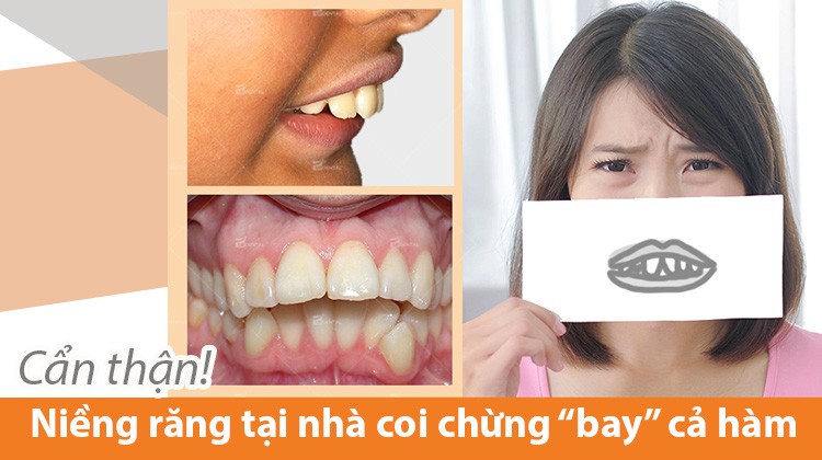 Niềng răng tại nhà và những nguy cơ khó lường