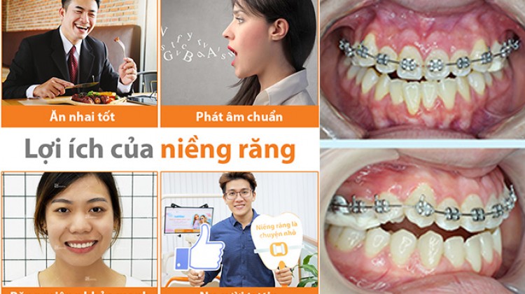 Niềng răng là gì? Top 10 tác dụng niềng răng mang lại