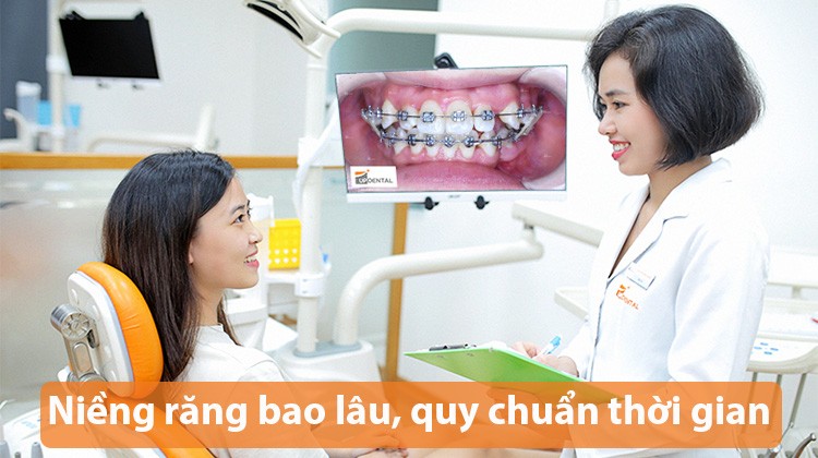 Niềng răng bao lâu, quy chuẩn về thời gian niềng răng