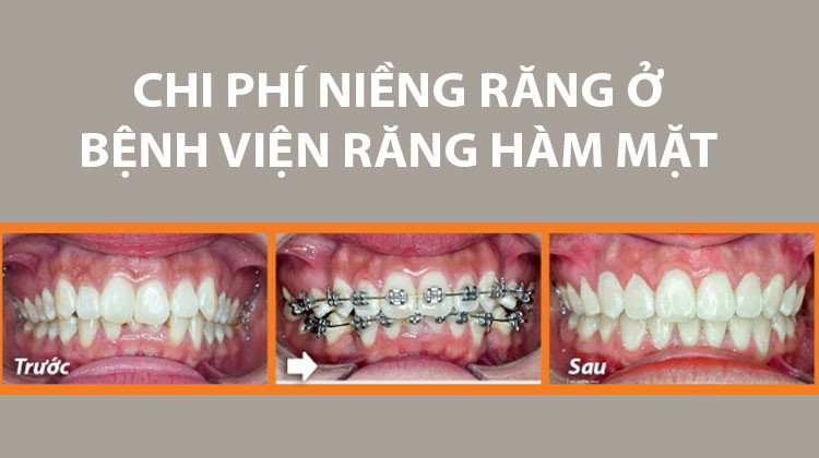 Giá niềng răng ở bệnh viện răng hàm mặt trung ương [Cập nhật] 