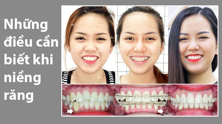 Những điều cần biết và lưu ý khi niềng răng
