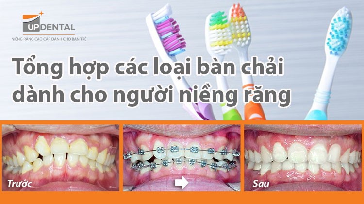 Tổng hợp các loại bàn chải dành cho người niềng răng