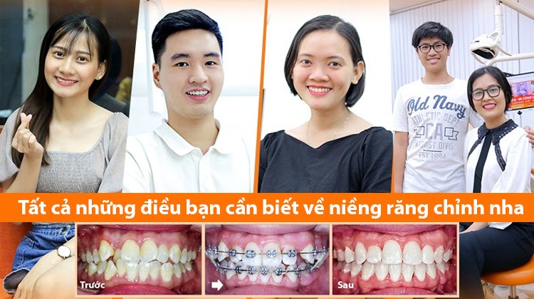 Tư vấn niềng răng: Tất cả những điều bạn cần biết về niềng răng chỉnh nha