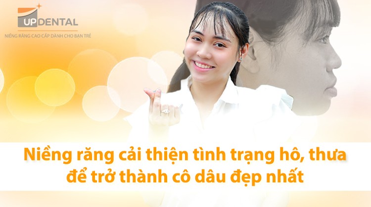 Niềng răng cải thiện tình trạng hô, thưa để trở thành cô dâu đẹp nhất