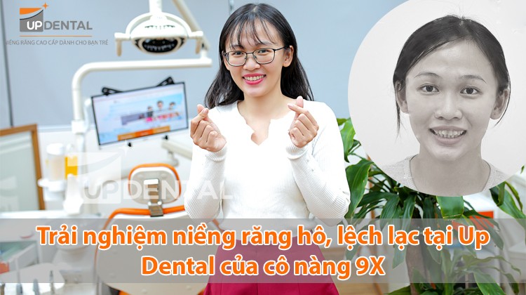 Trải nghiệm niềng răng hô tại Up Dental của cô nàng 9X