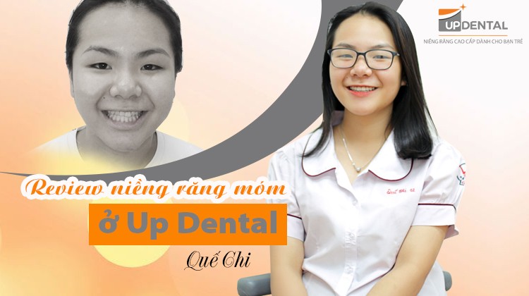 Review niềng răng móm ở Up Dental của cô bạn Quế Chi
