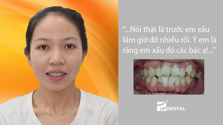 Chia sẻ: Hành trình niềng răng lệch lạc sở hữu hàm răng đẹp khách hàng Kim Liên