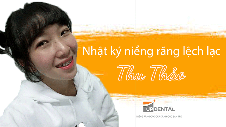 Điều trị răng lệch lạc bằng phương pháp niềng răng - Thu Thảo