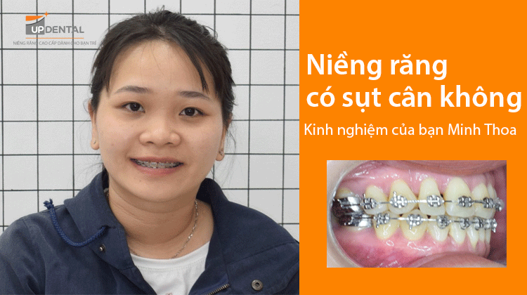 Niềng răng có sụt cân không - Kinh nghiệm của bạn Minh Thoa