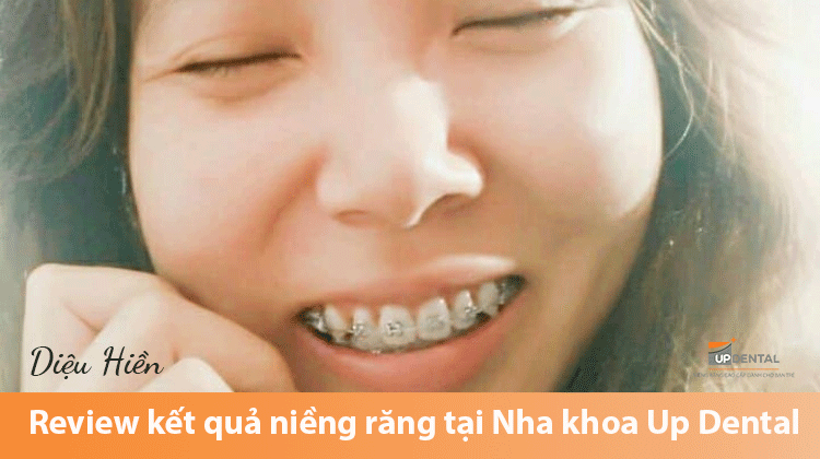 Review kết quả niềng răng tại Nha khoa Up Dental - Khách hàng Diệu Hiền