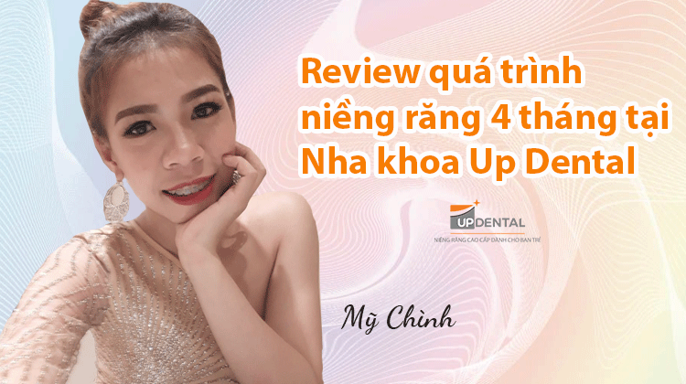 Review quá trình niềng răng 4 tháng tại Nha khoa Up Dental