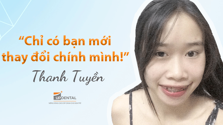 Kinh nghiệm và quy trình niềng răng mắc cài kim loại - Khách hàng Thanh Tuyền