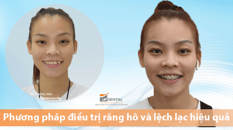 Phương pháp điều trị răng hô và lệch lạc hiệu quả - Thảo Ngân