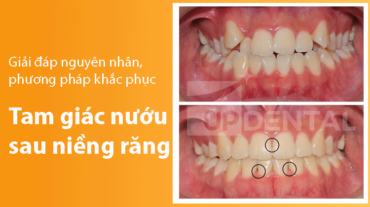 Tam giác đen sau khi niềng răng và cách khắc phục