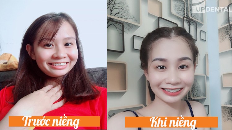 Cảm nhận các giai đoạn niềng răng của Hà Thị Trang 