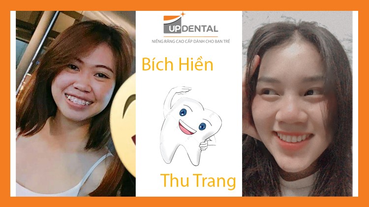 Sau niềng răng, Bích Hiền và Thu Trang nói gì về kết quả?