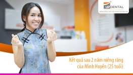 Kết quả sau 2 năm niềng răng của Minh Huyền (25 tuổi)