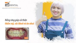 Niềng răng giúp cải thiện thẩm mỹ, sức khoẻ và ăn nhai