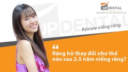 Răng hô thay đổi như thế nào sau 2.5 năm niềng răng - review của Anh Phương
