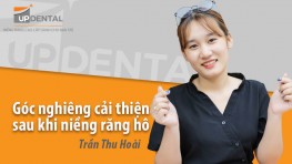 Góc nghiêng cải thiện sau khi niềng răng hô