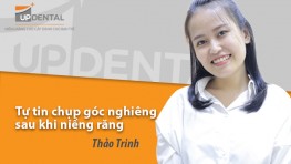 Tự tin chụp góc nghiêng sau khi niềng răng - Review niềng răng Thảo Trinh