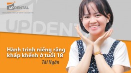 Tài Ngân và hành trình niềng răng khấp khểnh ở tuổi 18