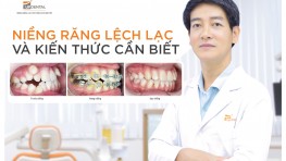 Niềng răng lệch lạc hiệu quả tiết kiệm chi phí ở Up Dental