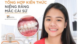 Niềng răng mắc cài sứ giá bao nhiêu [09/2024] tại Up Dental