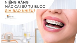 Niềng răng mắc cài sứ tự buộc là gì? Giá bao nhiêu?