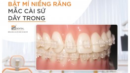 Phương pháp niềng răng mắc cài sứ dây trong là gì?