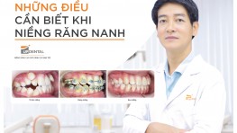 Niềng răng nanh và những lưu ý quan trọng