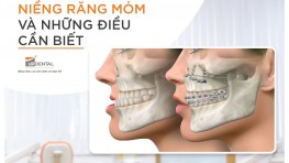 Niềng răng móm bằng phương pháp nào? Có hiệu quả không?