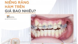 Chỉ niềng răng hàm trên có được không? Giá bao nhiêu?