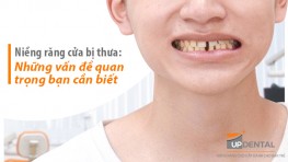 Niềng răng cửa bị thưa và các vấn đề bạn cần quan tâm