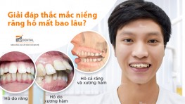 Niềng răng hô mất bao lâu? Quá trình niềng răng hô?
