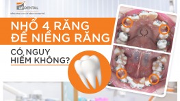 [Thắc mắc] Niềng răng nhổ 4 cái có nguy hiểm không?