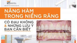 Nâng hàm trong niềng răng là gì? Có đau không?