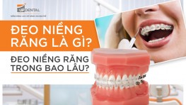 Đeo niềng răng trong bao lâu? Lưu ý khi đeo niềng răng